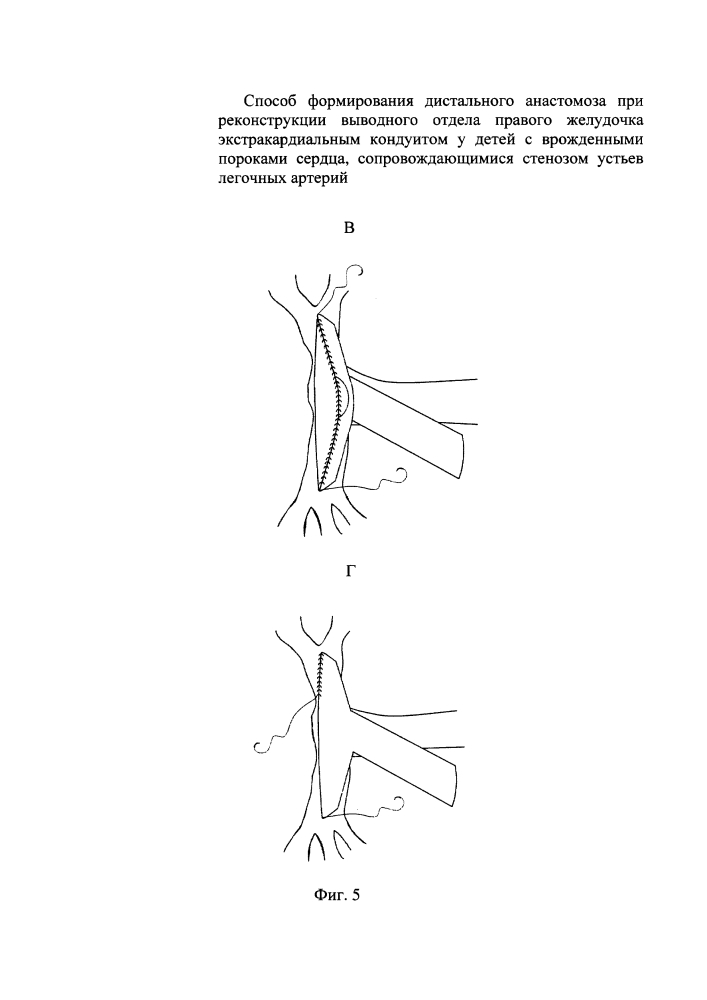 Способ формирования дистального анастомоза при реконструкции выводного отдела правого желудочка экстракардиальным кондуитом у детей с врожденными пороками сердца, сопровождающимися стенозом устьев легочных артерий (патент 2639030)