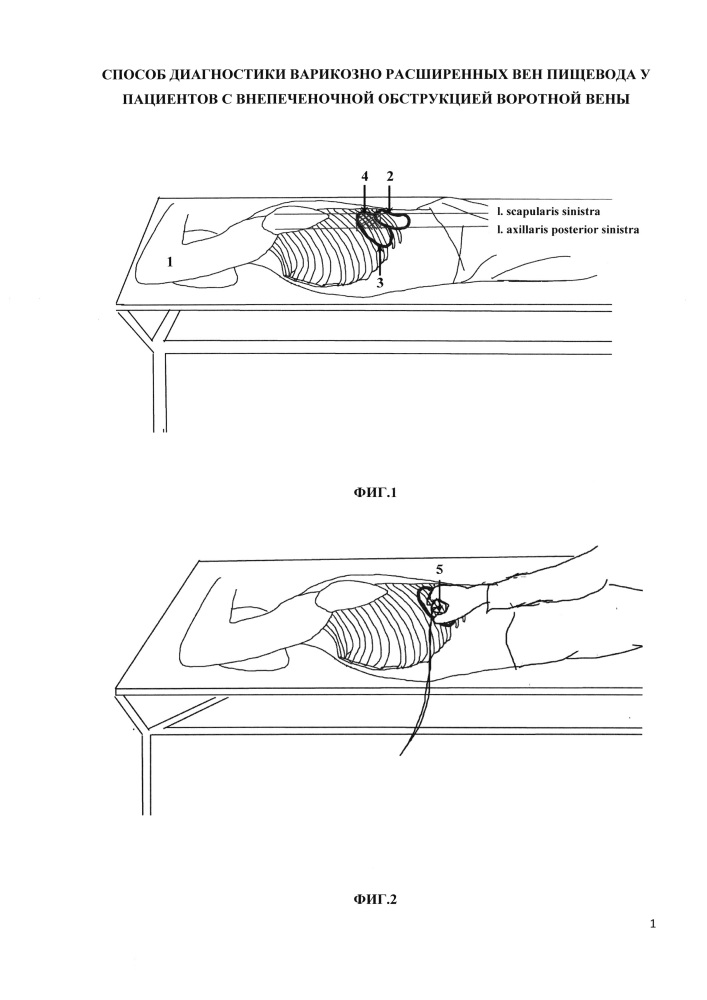 Способ диагностики варикозно расширенных вен пищевода у пациентов с внепеченочной обструкцией воротной вены (патент 2632778)