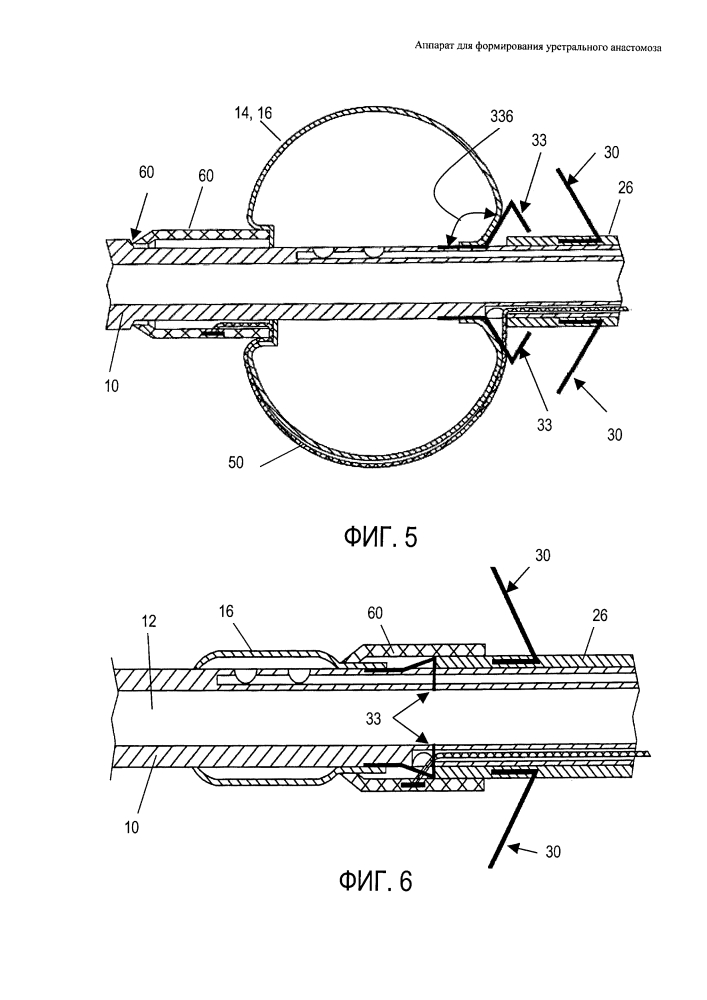 Аппарат для формирования уретрального анастомоза (патент 2632764)