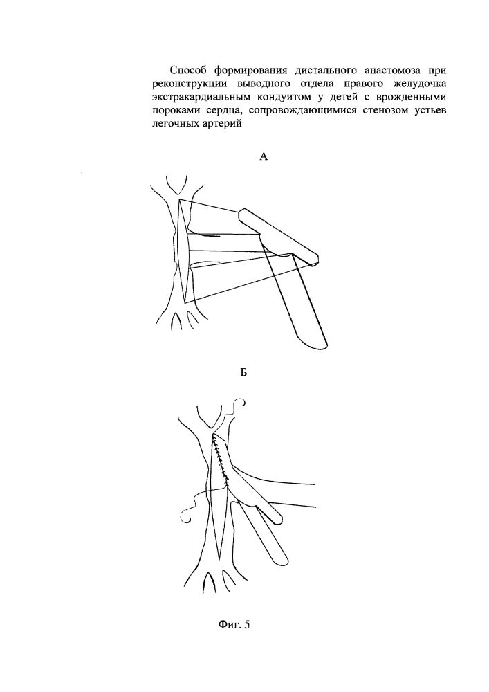Способ формирования дистального анастомоза при реконструкции выводного отдела правого желудочка экстракардиальным кондуитом у детей с врожденными пороками сердца, сопровождающимися стенозом устьев легочных артерий (патент 2639030)