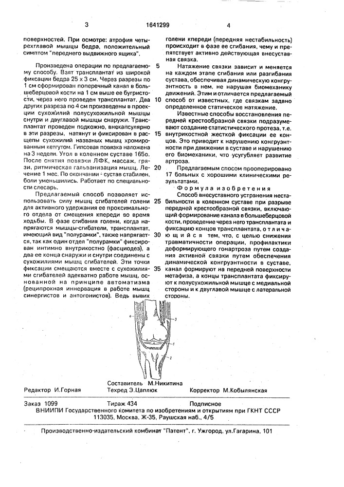 Способ внесуставного устранения нестабильности в коленном суставе при разрыве передней крестообразной связки (патент 1641299)
