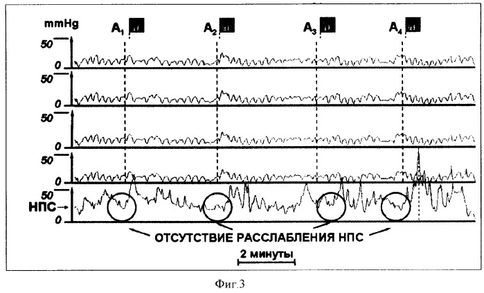 Способ диагностики моторных нарушений пищевода (патент 2339303)