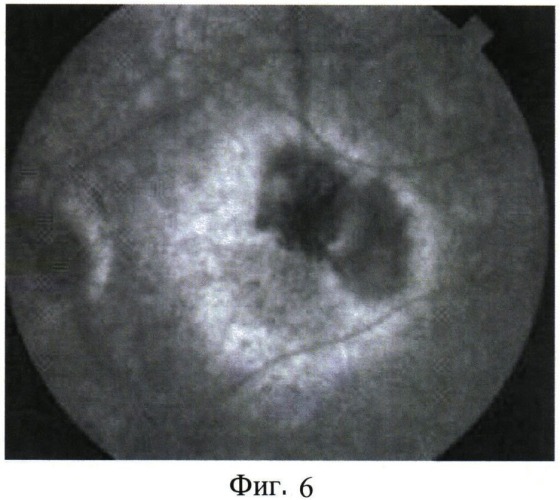 Способ лечения "влажной" формы возрастной макулярной дегенерации (патент 2541834)