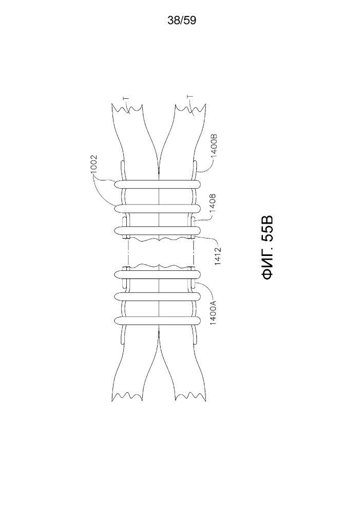 Съемный слой материала и хирургический концевой зажим со съемным слоем материала (патент 2661143)