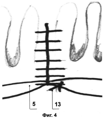 Способ ушивания ран анального канала после геморроидэктомии (патент 2550732)
