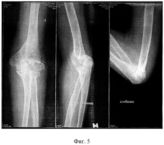 Способ восстановления функции локтевого сустава при псевдоартрозе мыщелка плечевой кости (патент 2521536)