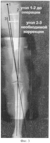 Способ предоперационного планирования корригирующих остеотомий костей голени для исправления о-образной формы ног (патент 2547252)