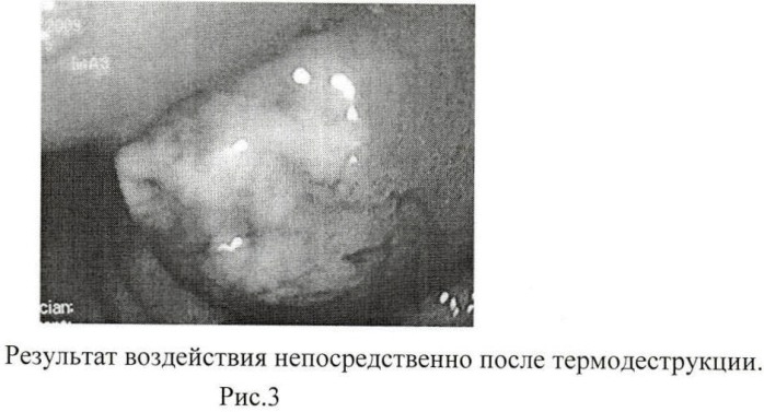 Способ термической деструкции новообразований в полых внутренних органах (патент 2455920)