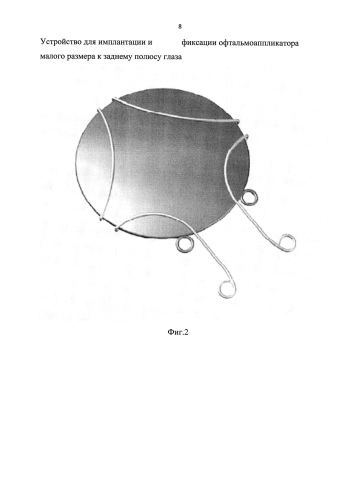 Устройство для имплантации и фиксации офтальмоаппликатора малого размера к заднему полюсу глаза (патент 2591657)