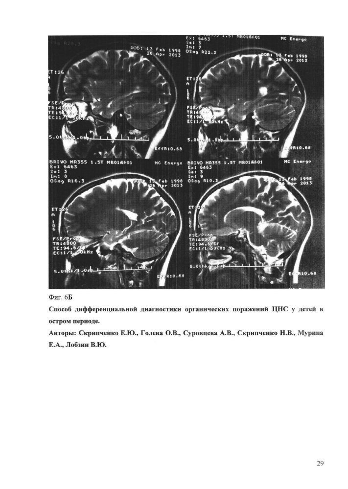 Способ дифференциальной диагностики органических поражений цнс у детей в остром периоде (патент 2648215)