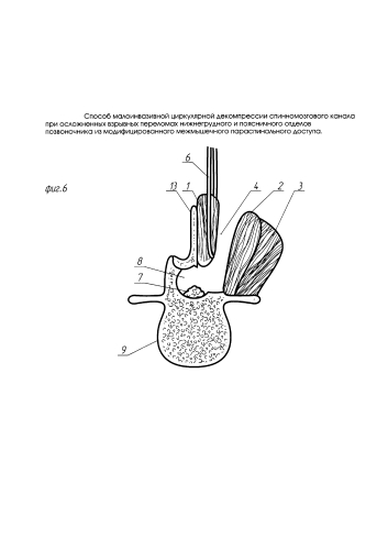 Способ малоинвазивной циркулярной декомпрессии спинномозгового канала при осложненных взрывных переломах нижнегрудного и поясничного отделов позвоночника из модифицированного межмышечного параспинального доступа (патент 2592779)
