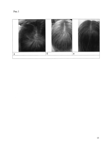 Способ получения средства для лечения нерубцовых алопеций (патент 2583552)