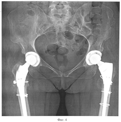 Способ эндопротезирования тазобедренного сустава с использованием корригирующей остеотомии (патент 2533971)
