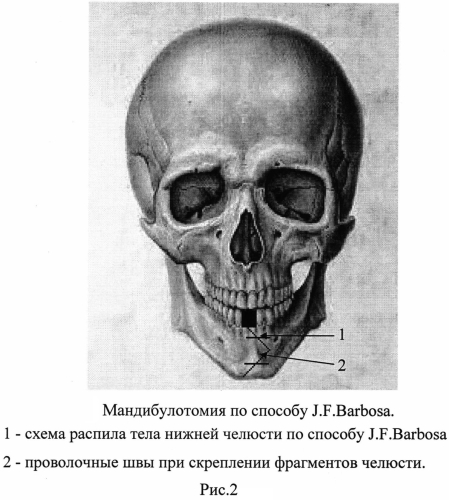 Способ хирургического лечения рака органов полости рта и ротоглотки (патент 2556604)