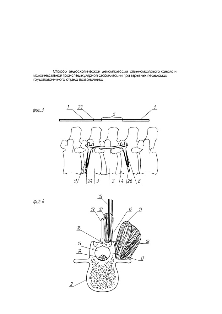 Способ эндоскопической декомпрессии спинномозгового канала и малоинвазивной транспедикулярной стабилизации при взрывных переломах грудопоясничного отдела позвоночника (патент 2649826)