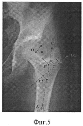 Способ лечения деформаций проксимального отдела бедра (патент 2528964)