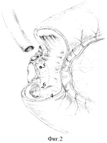 Способ хирургического лечения постбульбарных язв двенадцатиперстной кишки, осложненных холедоходуоденальным свищом (патент 2316262)