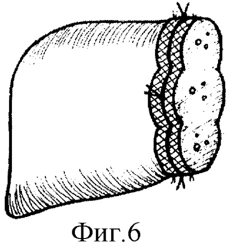 Способ резекции печени (патент 2278617)