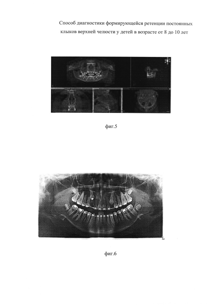 Способ диагностики формирующейся ретенции постоянных клыков верхней челюсти у детей в возрасте от 8 до 10 лет (патент 2629329)