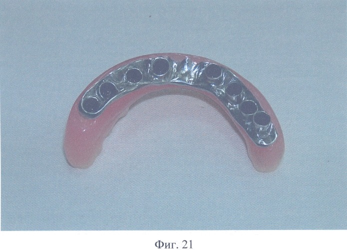 Зубной протез с опорой на внутрикостные имплантаты (патент 2326621)