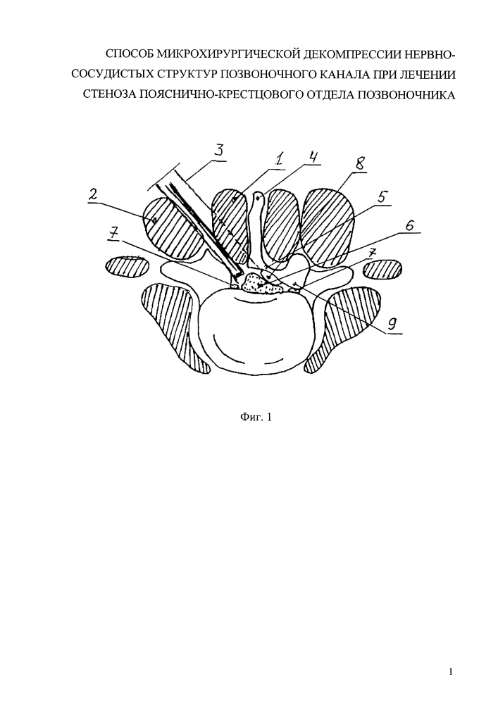 Способ микрохирургической декомпрессии нервно-сосудистых структур позвоночного канала при лечении стеноза пояснично-крестцового отдела позвоночника (патент 2628653)