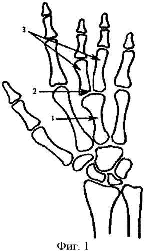 Способ реконструкции кисти при врожденной конкресценции центральных пястных костей у детей (патент 2373880)