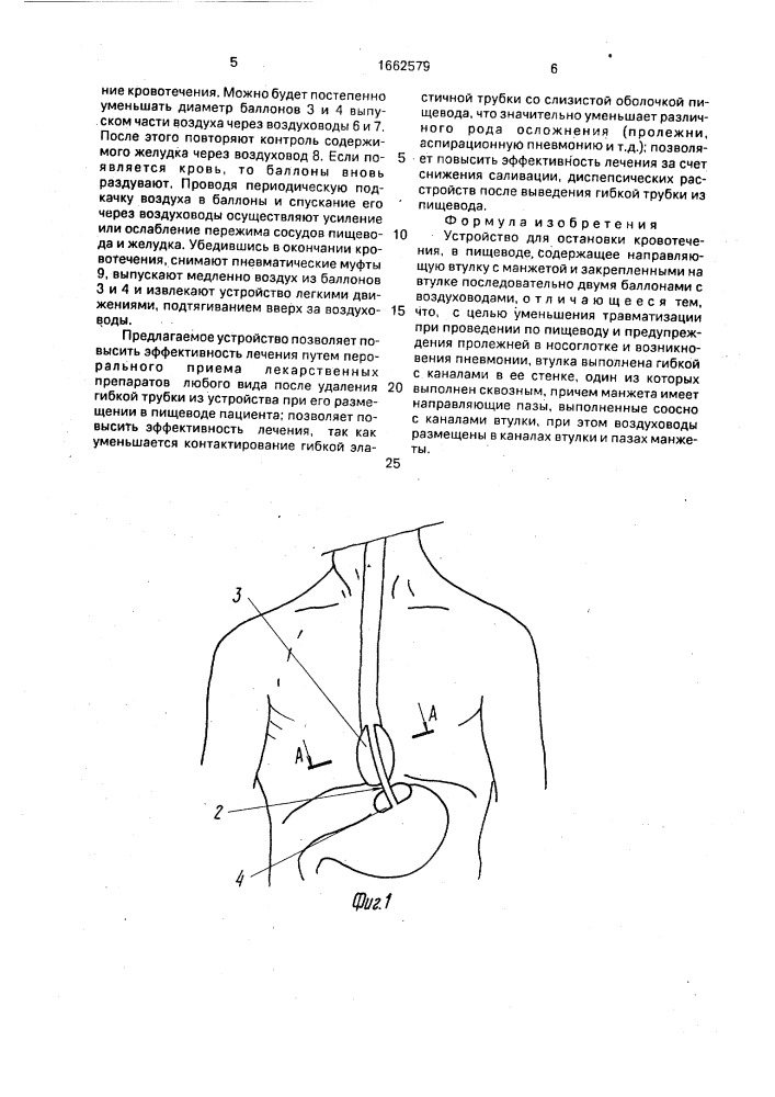 Устройство для остановки кровотечения в пищеводе (патент 1662579)