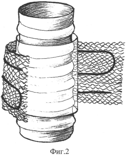 Способ замещения циркулярных дефектов трахеи (патент 2556855)