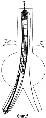 Эндоваскулярный бифуркационный имплантируемый протез (патент 2314778)