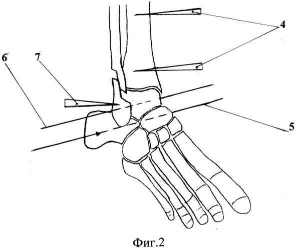 Способ лечения застарелых неправильно сросшихся пронационно-эверсионных переломов дистального отдела костей голени (патент 2528819)