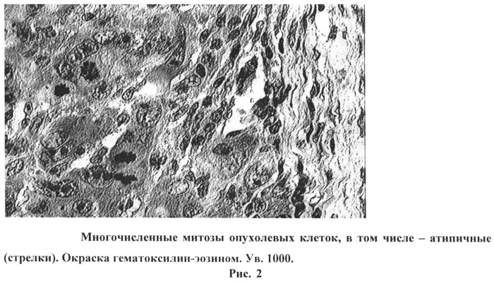 Способ получения метастазов печени в эксперименте (патент 2538243)