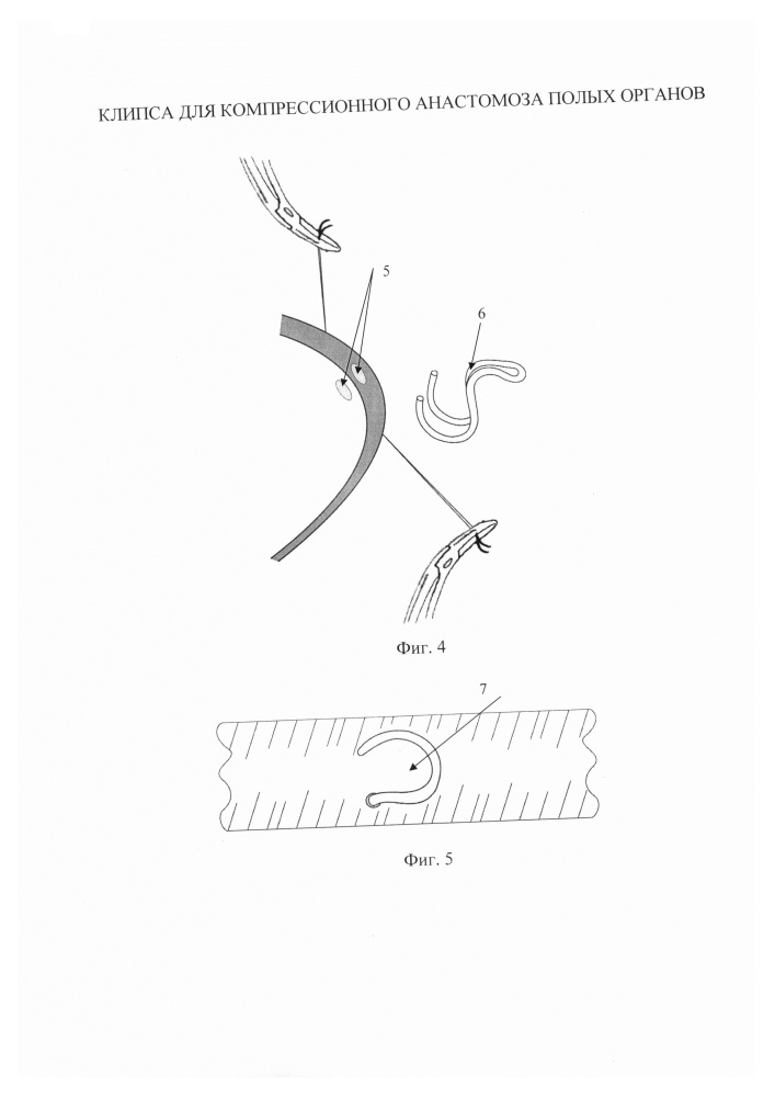 Клипса для компрессионного анастомоза полых органов (патент 2664188)
