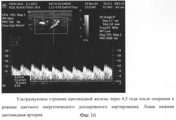 Способ хирургического лечения диффузного токсического зоба (патент 2281040)