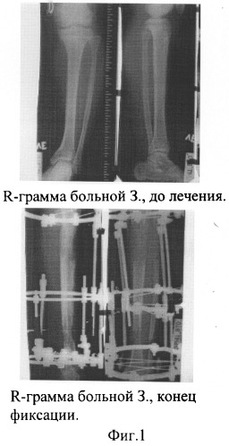 Способ удлинения сегментов конечностей (патент 2258483)