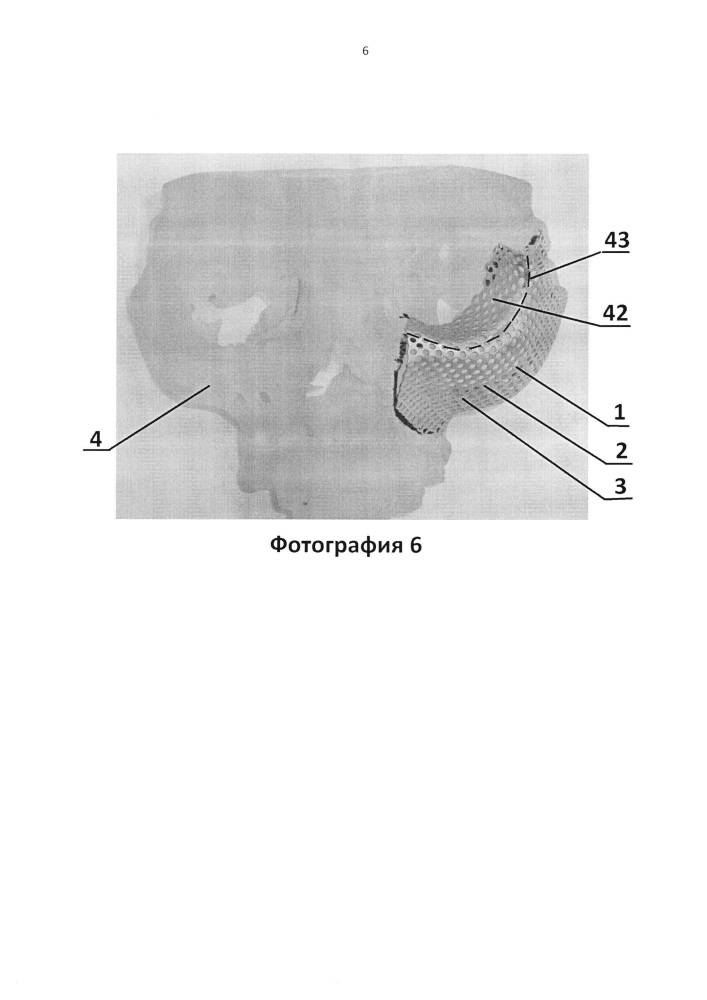 Имплантат для протезирования костей черепа и способ изготовления имплантата для протезирования костей черепа (патент 2638894)