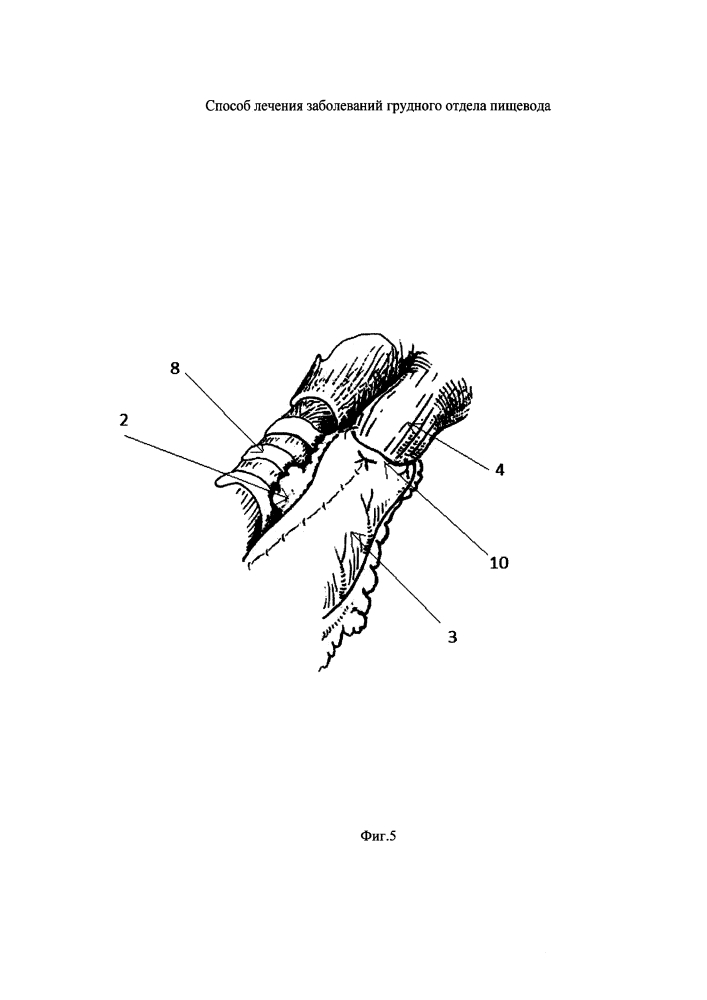 Способ лечения заболеваний грудного отдела пищевода (патент 2612098)