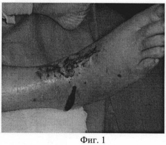 Способ купирования некроза краев кожи послеоперационной раны после эндопротезирования голеностопного сустава (патент 2476231)