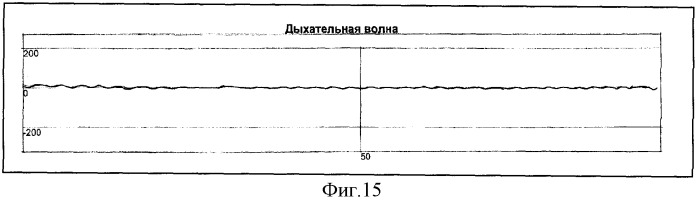 Способ определения типа демпинг-реакции при демпинг-синдроме (патент 2334456)