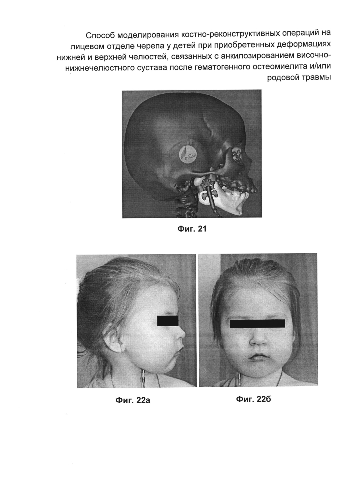 Способ моделирования костно-реконструктивных операций на лицевом отделе черепа у детей при приобретенных деформациях нижней и верхней челюстей, связанных с анкилозированием височно-нижнечелюстного сустава после гематогенного остеомиелита и/или родовой травмы (патент 2604774)