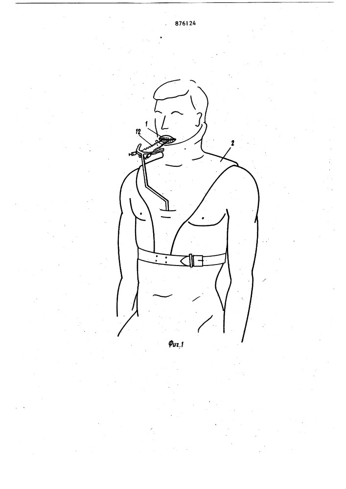 Аппарат для репозиции и фиксации отломков верхней челюсти (патент 876124)