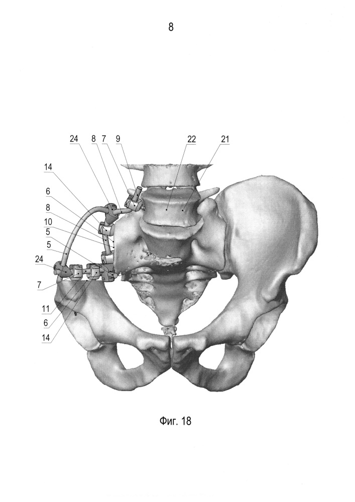 Способ реконструкции костей таза (патент 2625986)