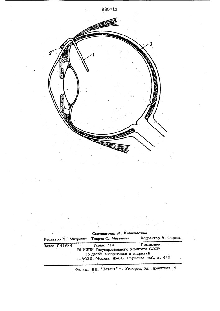 Устройство для введения жидких лекарств внутрь глаза (патент 980711)