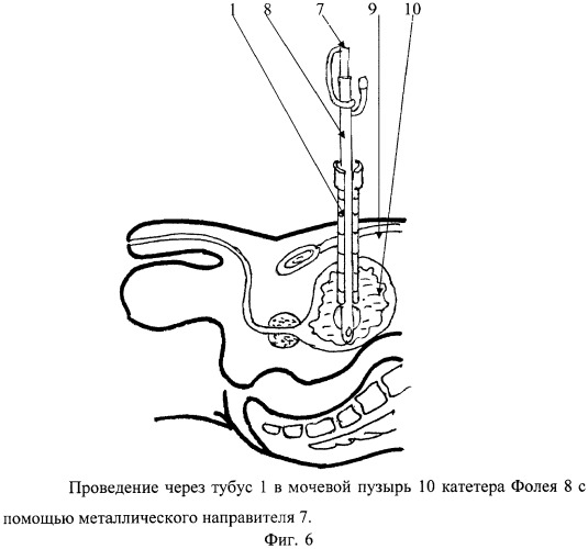 Устройство для проведения в мочевой пузырь фиксирующихся уретральных катетеров при троакарной цистостомии (патент 2408311)
