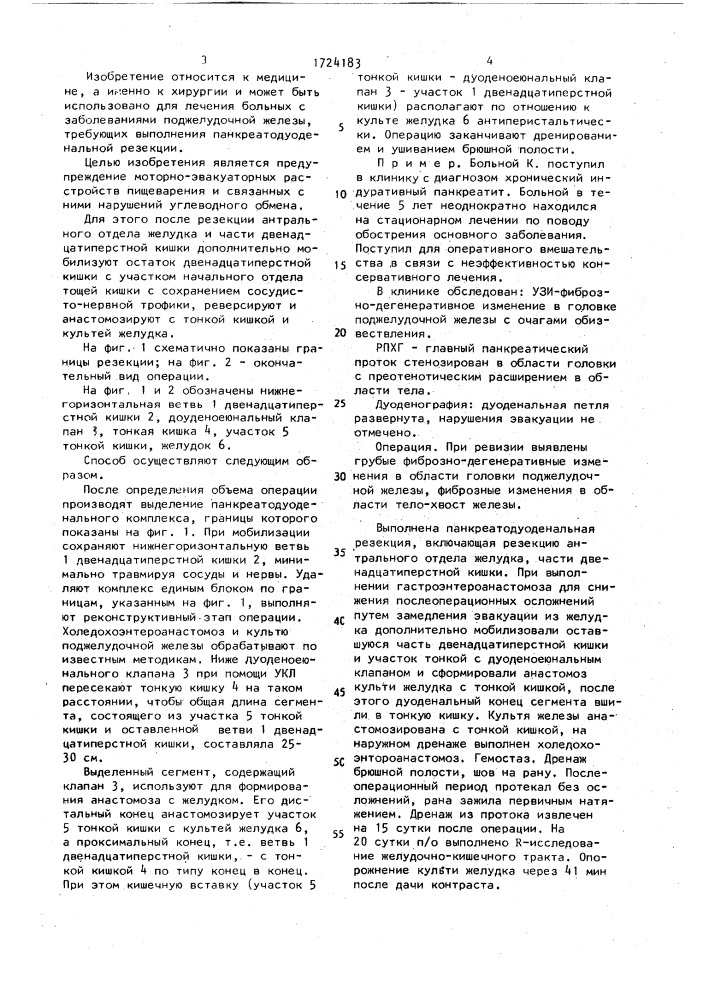 Способ панкреатодуоденальной резекции (патент 1724183)