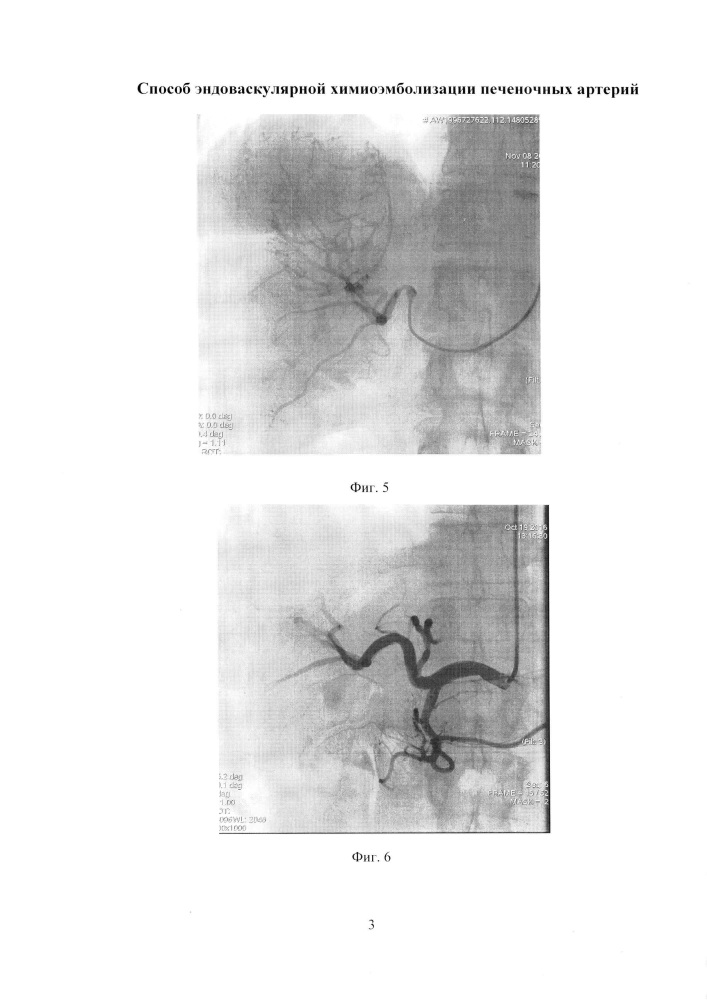Способ эндоваскулярной химиоэмболизации печеночных артерий (патент 2655191)