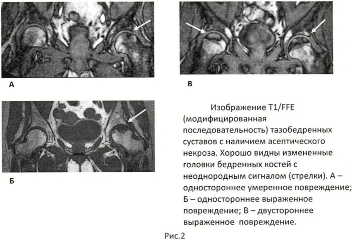 Скрининговый способ диагностики асептического некроза суставных концов костей крупных суставов (патент 2436512)