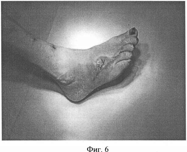 Способ комплексного лечения больных с синдромом диабетической стопы (патент 2328323)