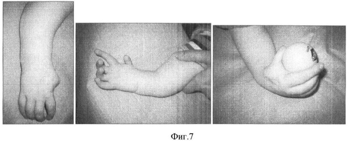Способ лечения врожденной лучевой косорукости (патент 2372863)