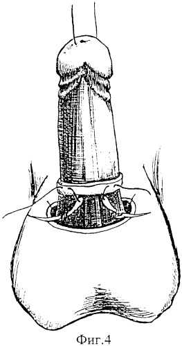 Способ высвобождения кавернозных и спонгиозного тел и удлинения видимой части ствола полового члена (патент 2350284)