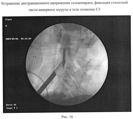 Способ анкерной коррекции и фиксации травматических дислокаций тела позвонка с2 при переломах палача (патент 2463978)